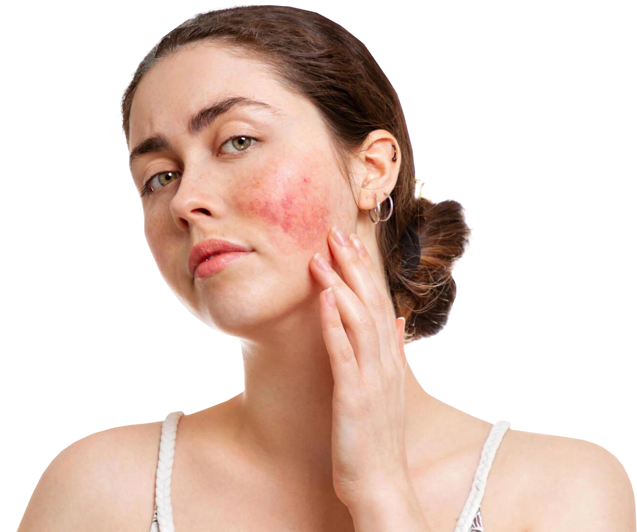 Rosacea Treatment in Fresno, CA Banner