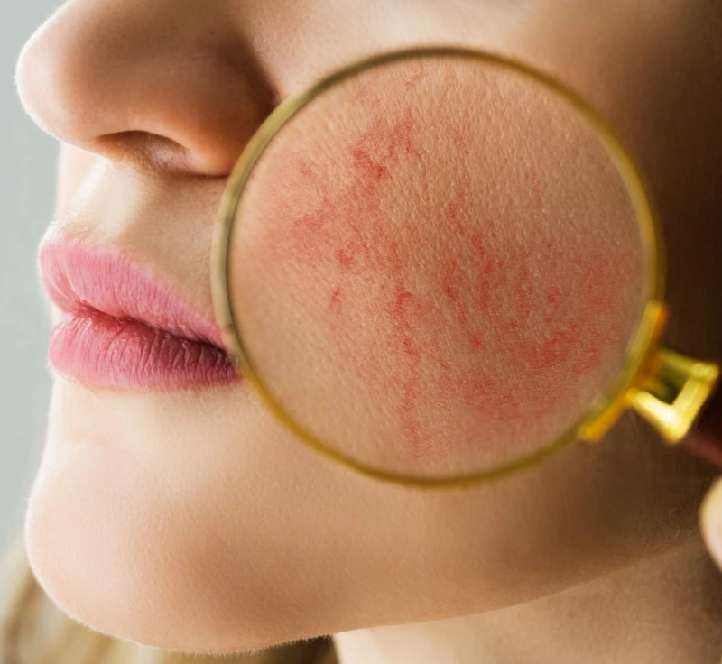 Rosacea Treatment Procedure Banner