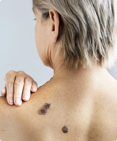 Cost of Melanoma Treatment In Fresno, CA