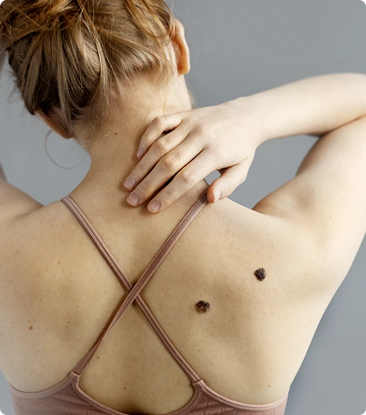 Causes of Melanoma image