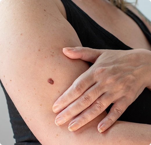 What is melanoma image?