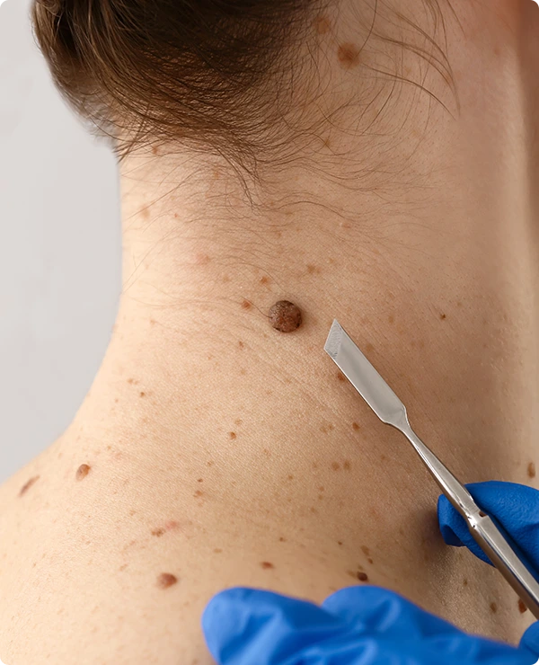 RECOVERY AFTER MOLE REMOVAL Banner
