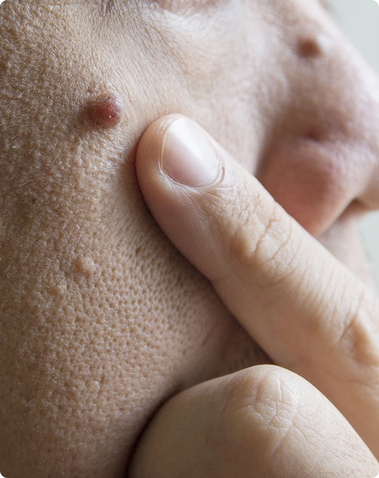 COST OF MOLE REMOVAL IN FRESNO Banner