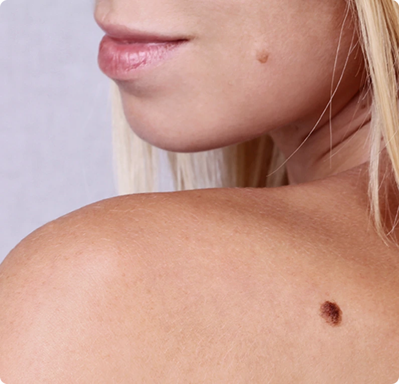 TYPES OF MOLES Banner