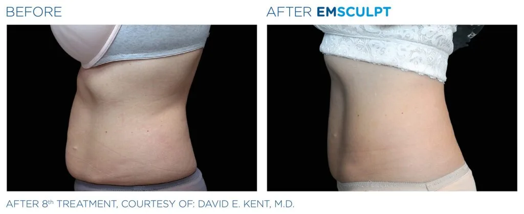 emsculpt-abdomen-female-Emsculpt_PIC_Bacardfemaleabdomen002_ENUS100