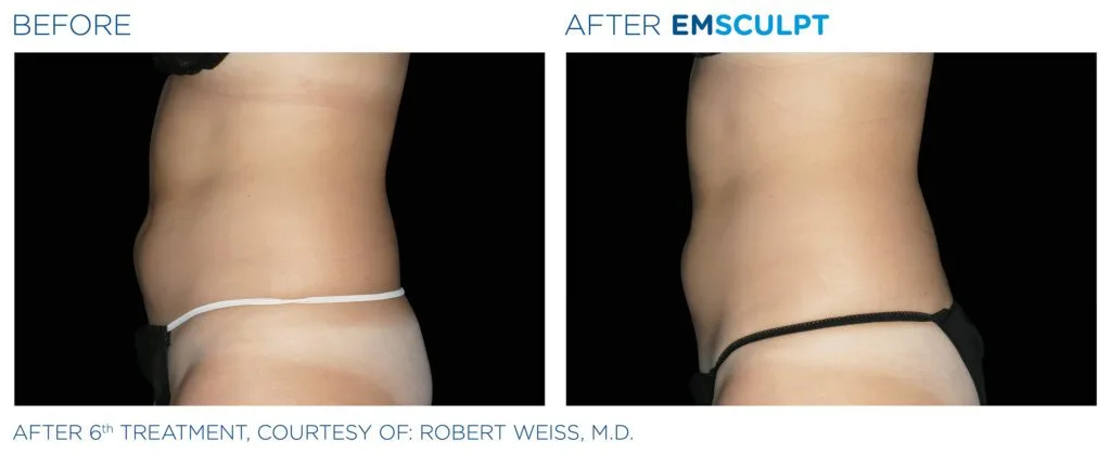 emsculpt-abdomen-female-Emsculpt_PIC_Bacardfemaleabdomen010_ENUS100