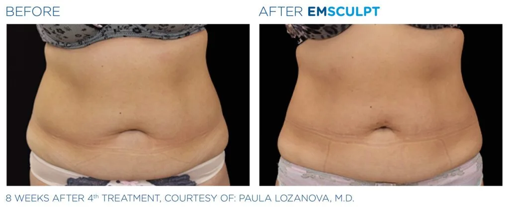 emsculpt-abdomen-female-Emsculpt_PIC_Bacardfemaleabdomen027_ENUS100-1