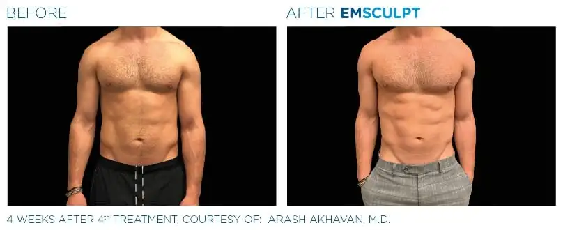 emsculpt-before-and-after-abs