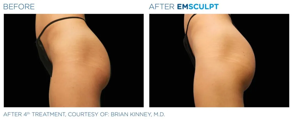 emsculpt-buttocks-female-Emsculpt_PIC_Bacardfemalebuttock021_ENUS100