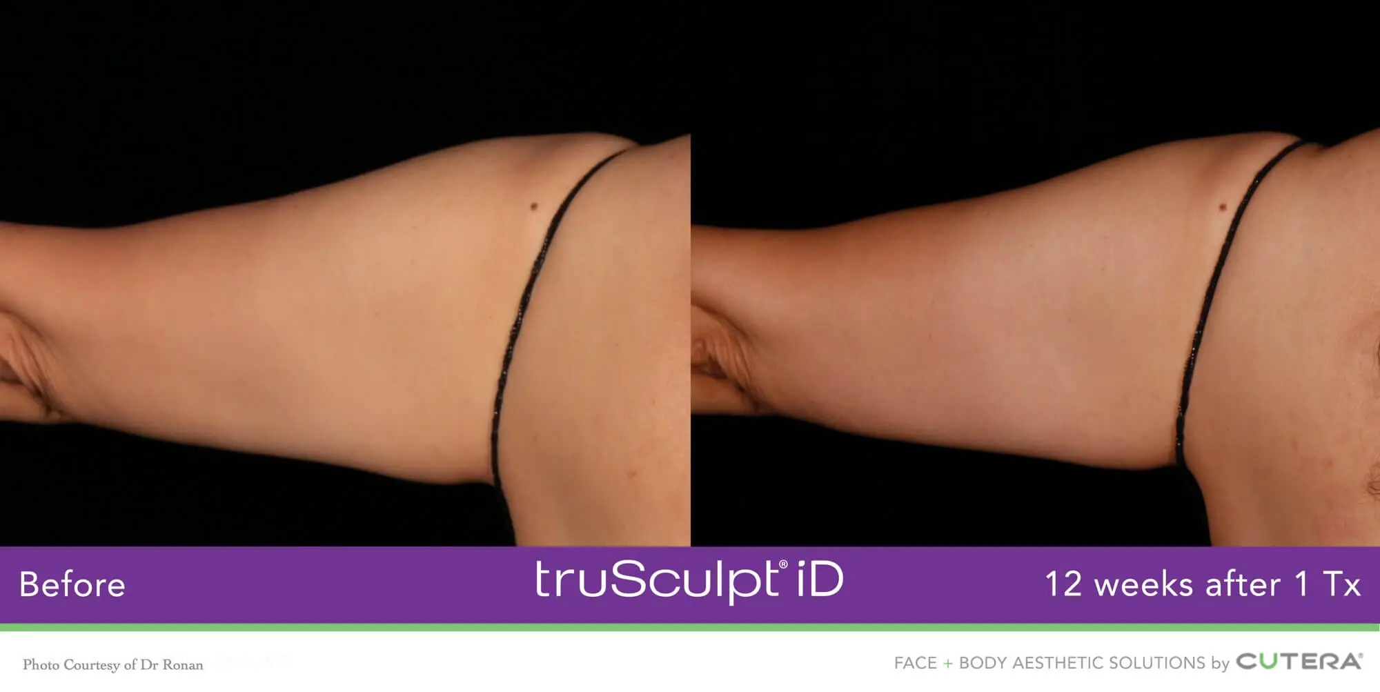 truSculpt-iD-Ronan-6-1