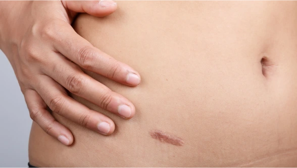 Candidates for Keloid Scar Removal