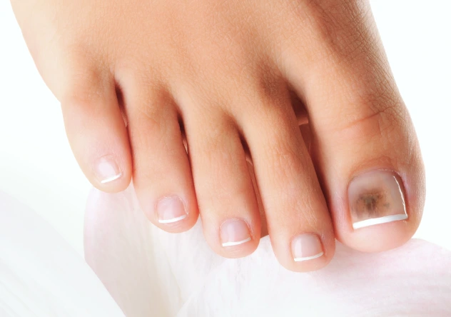 What Is Nail Fungus