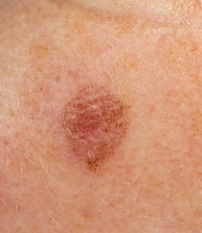 Actinic Keratosis Treatment in Fresno, CA: What Is Actinic Keratosis? Banner