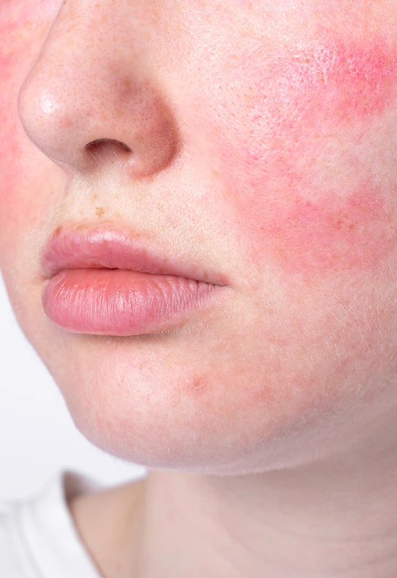 Atopic Dermatitis Fresno, CA: Atopic Dermatitis Treatment Options Banner