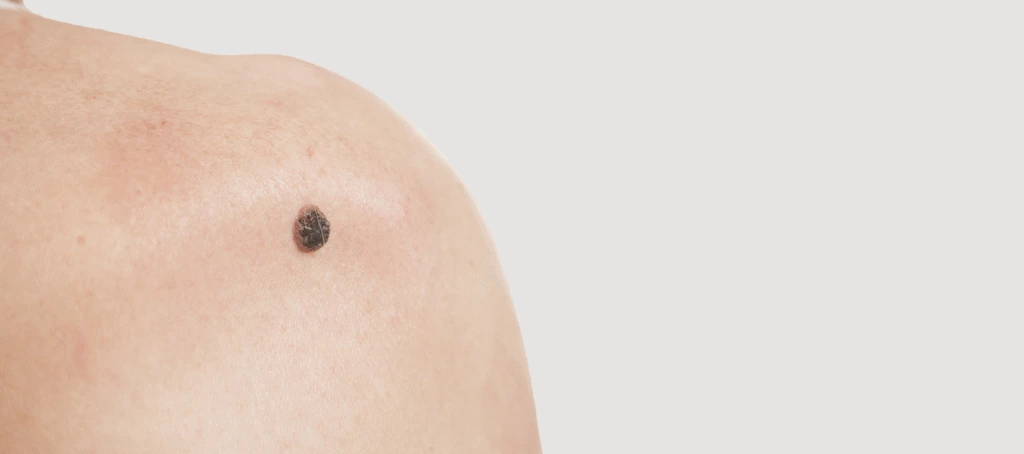 Candidates for Basal Cell Carcinoma Treatment Banner