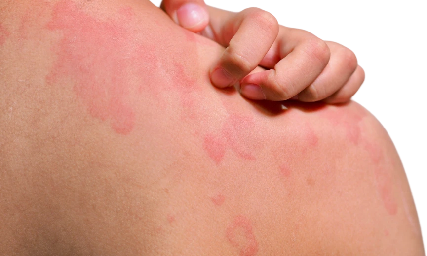 What Is a Skin Rash Banner