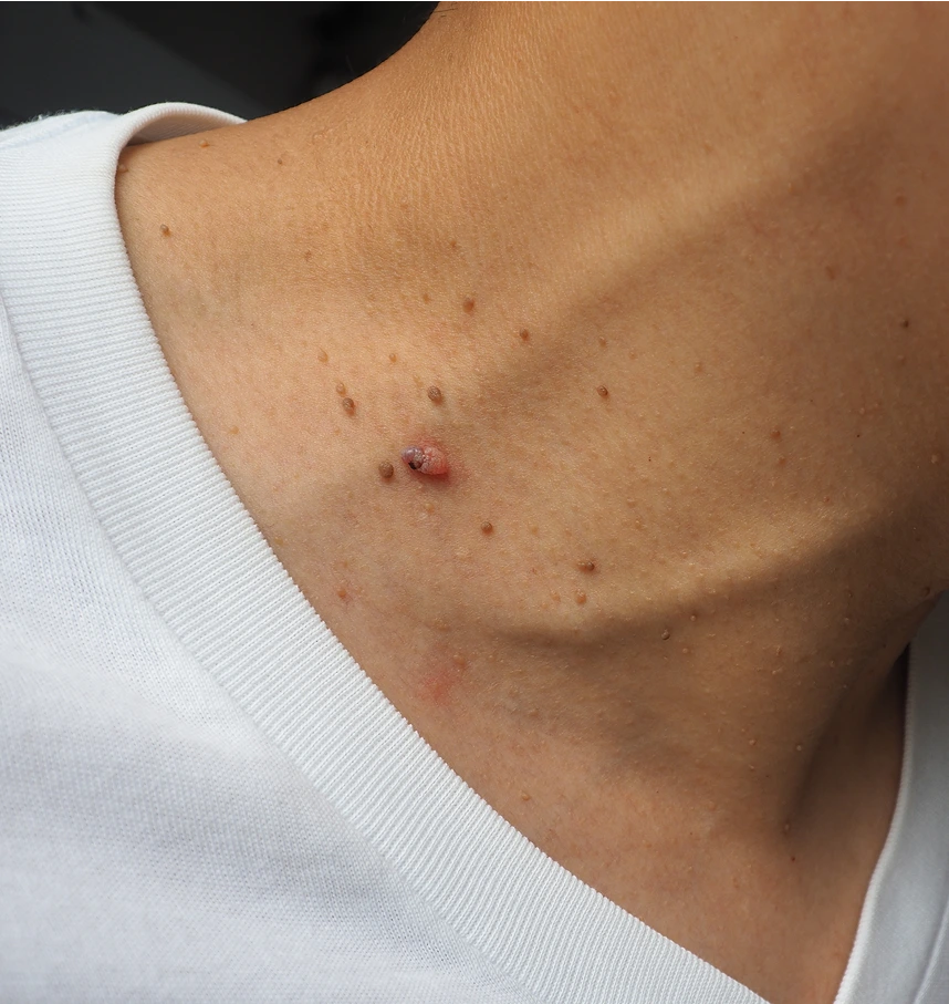 Benefits of Skin Tag Removal Fresno, California Banner