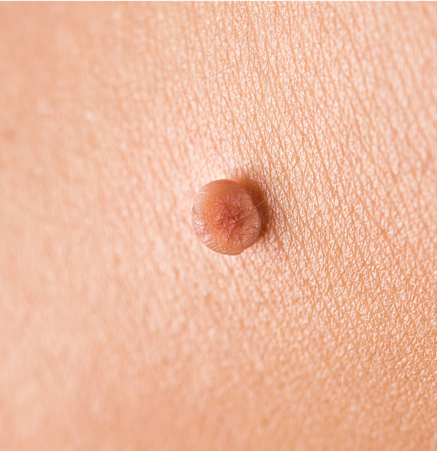 How Is the Procedure Performed Skin Tag Removal in Fresno, California Banner