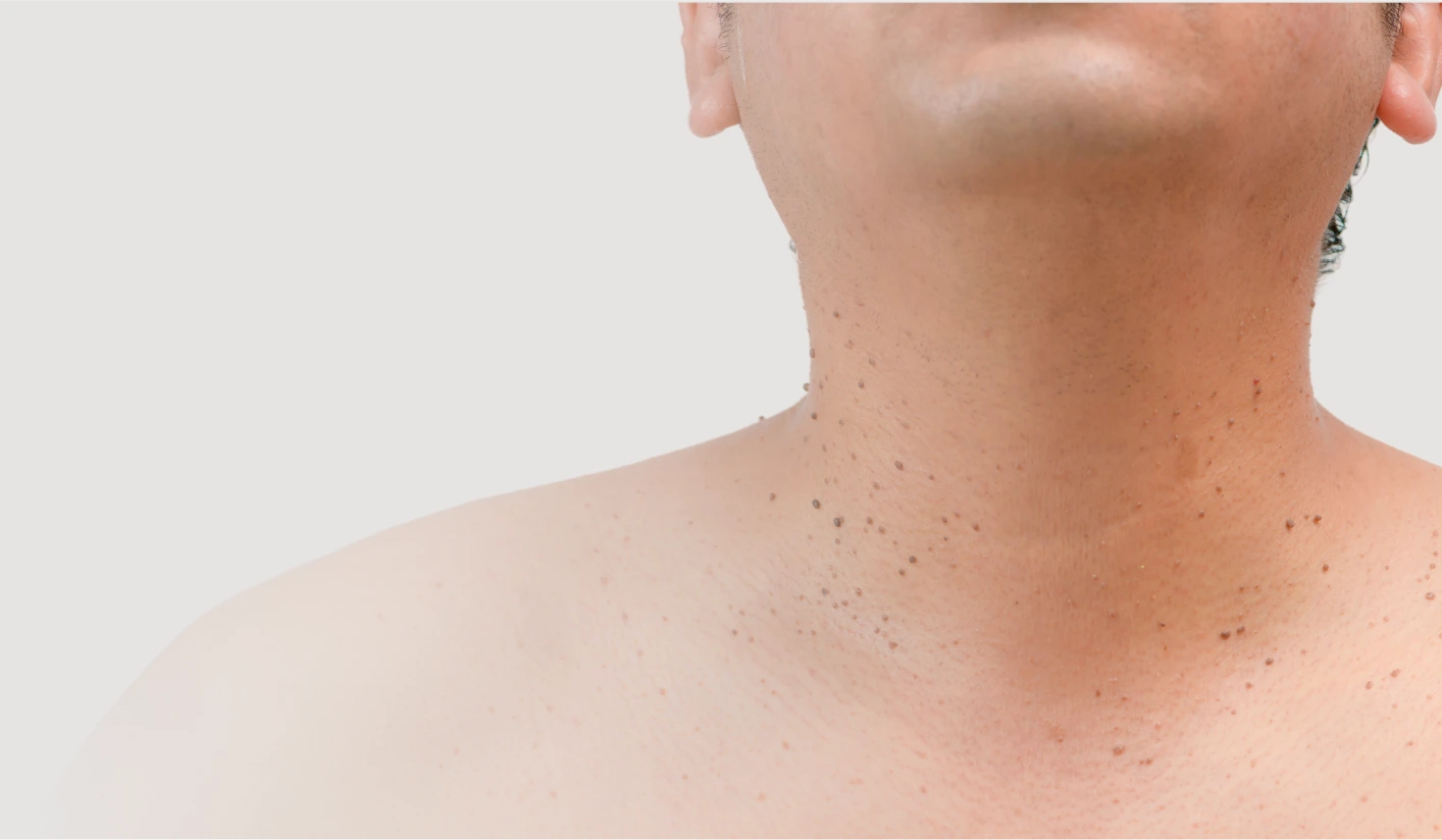 Ready for Skin Tag Removal? Contact Minarets Medical Group Today! Banner