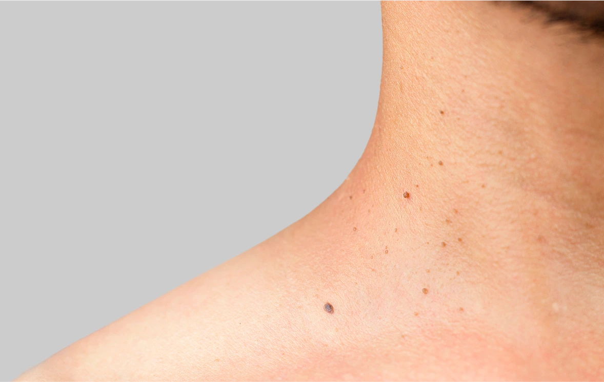 Skin Tag Removal in Fresno, CA Banner