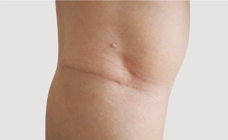 What Is a Skin Tag Fresno, CA Banner